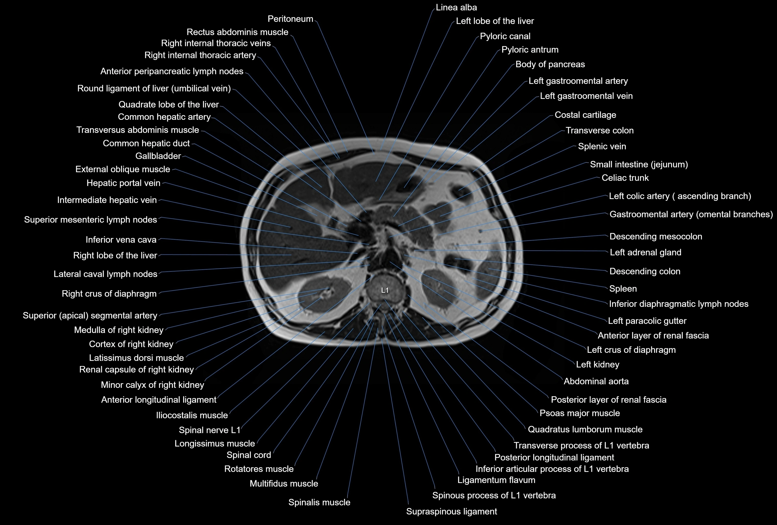 MRI Abdomen axial cross sectional anatomy radiology  image-img-00001-00017.webp